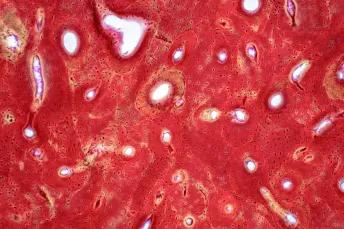 Pathology of human compact bone tissue under light microscope view